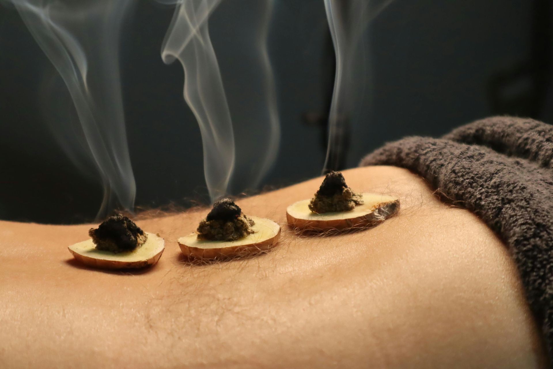 une personne qui est traitée avec de la moxibustion, des moxas sur gingembre