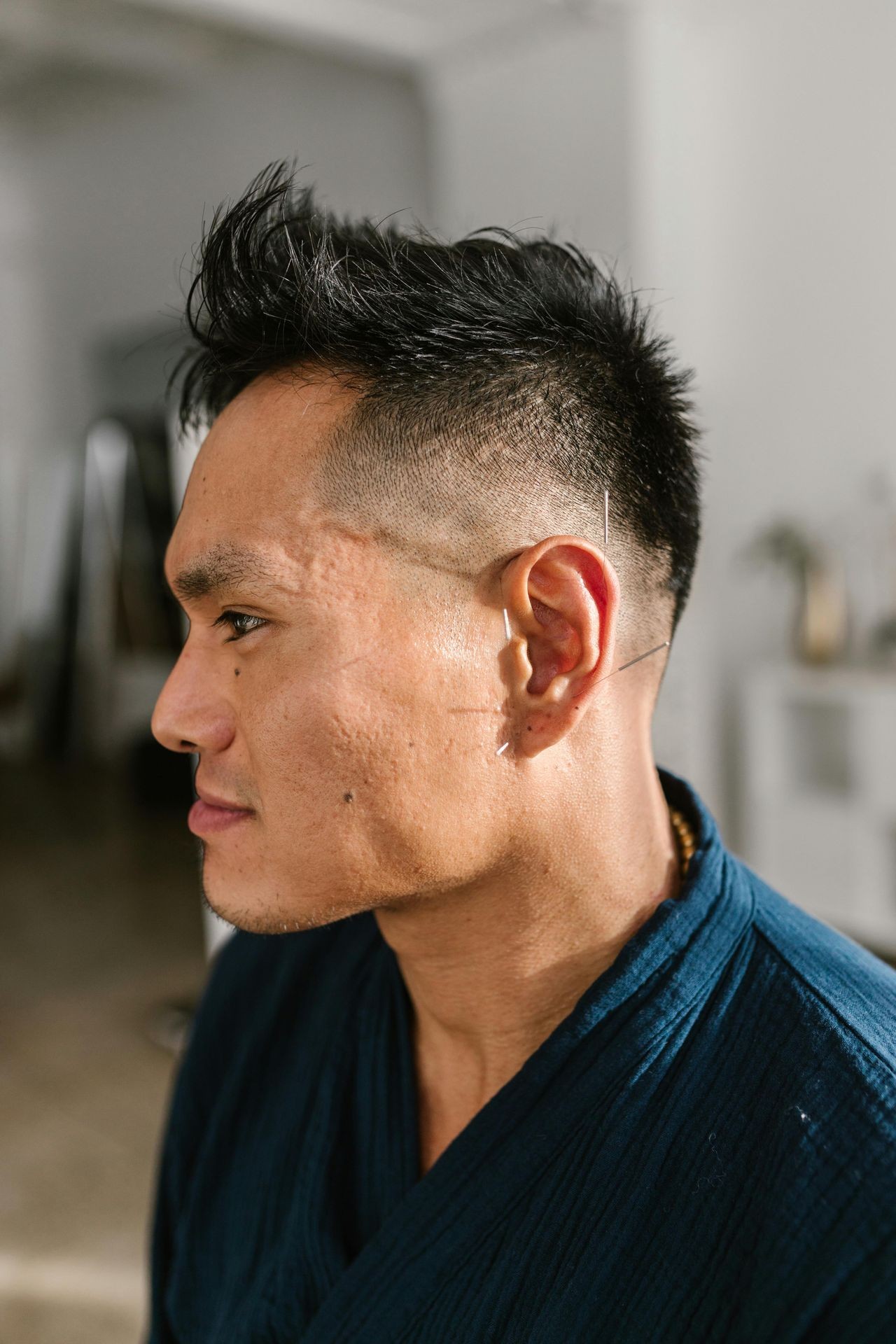 un patient homme avec des aiguilles d'acupuncture sur les oreilles et le crâne